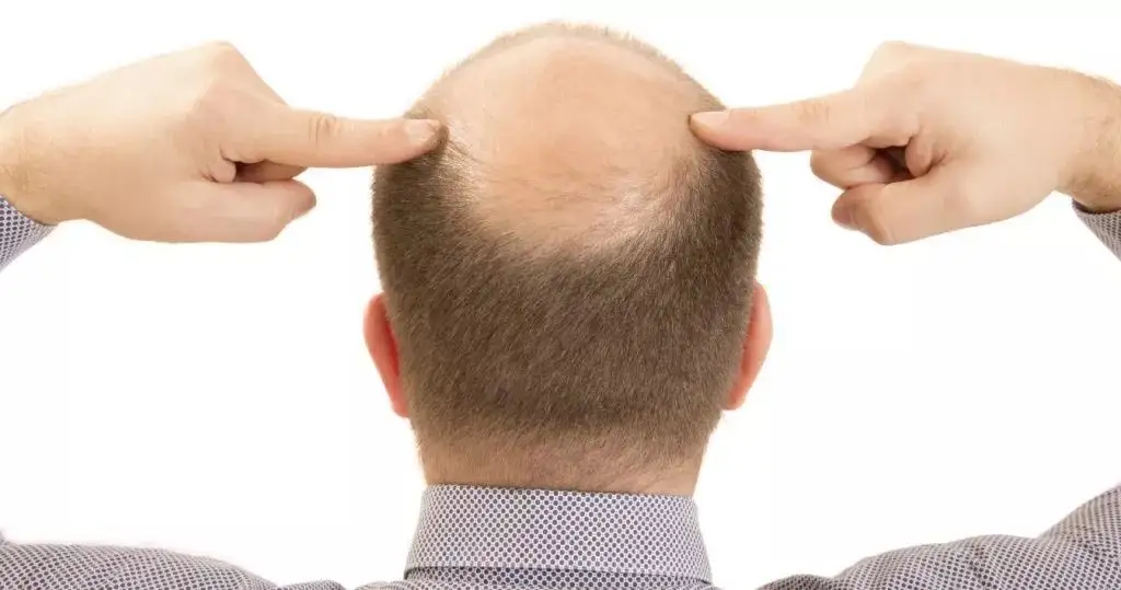 How To Prevent Hair Loss: Lifestyle, Acupressure Points, Scalp Massage, Shampoo & More